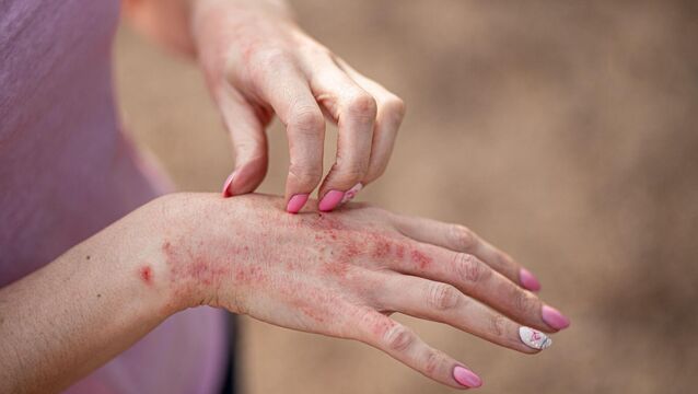 <p>There were 60,821 people waiting by January this year for treatment of their skin conditions, with 3% waiting over three years. File picture</p>