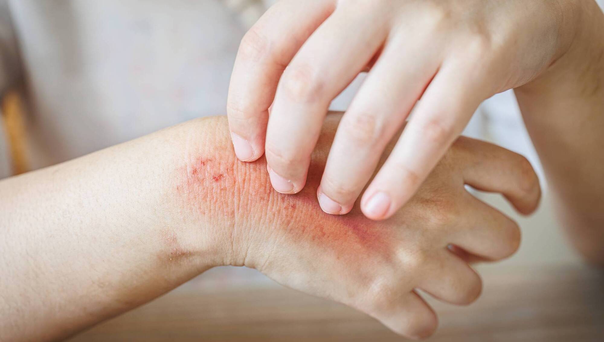 Dr Phil Kieran: My teenager got scabies on a camping trip