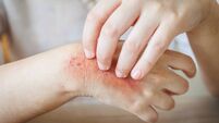 severe hand itching scratching. scary wound Itchy rash, allergies, fungal skin diseases