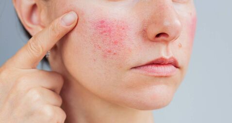 Woman suffering from rosacea on her face in the acute stage, she showing redness on her cheek.