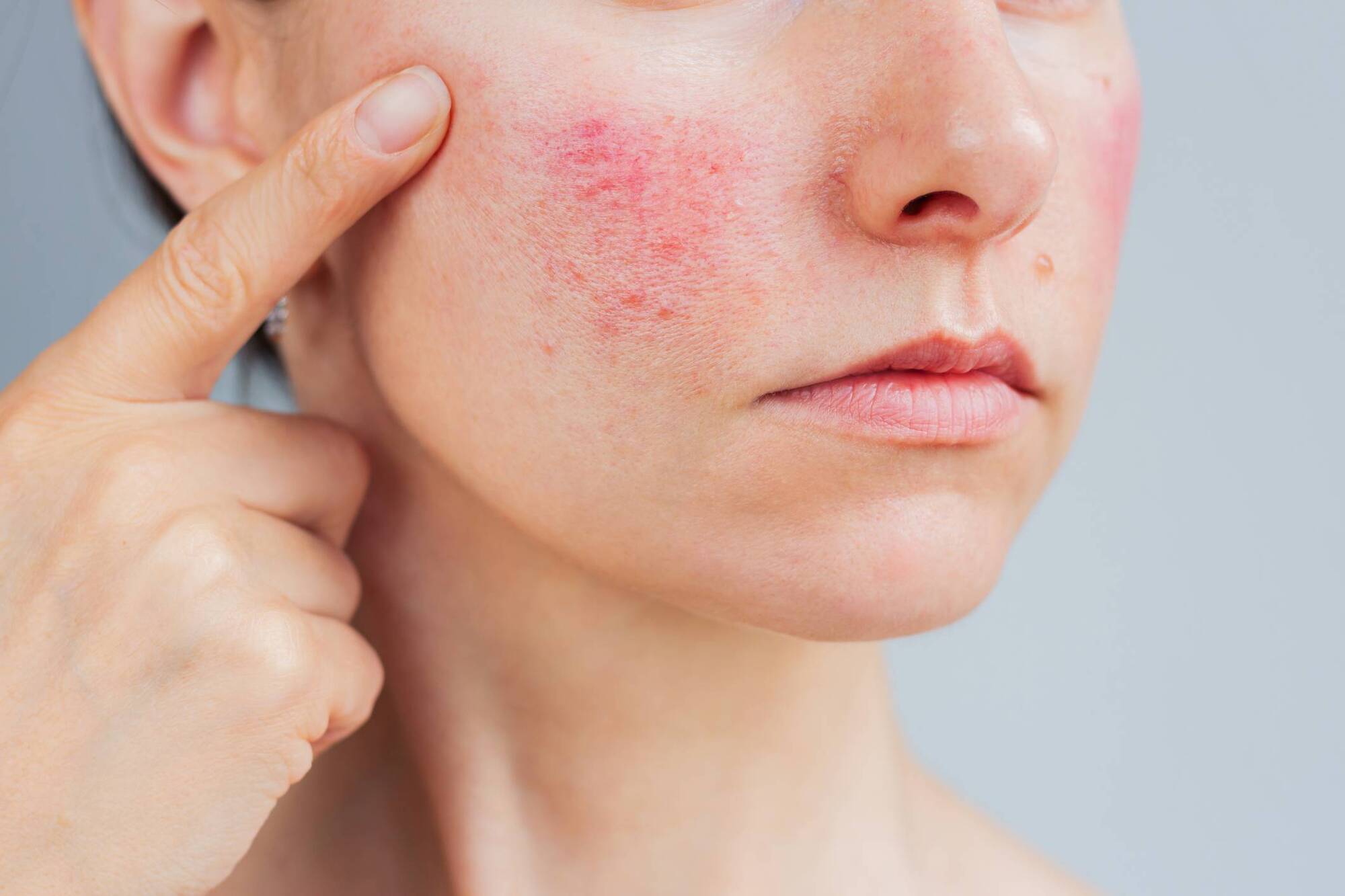Sally Foran: Everything I've learned about managing rosacea