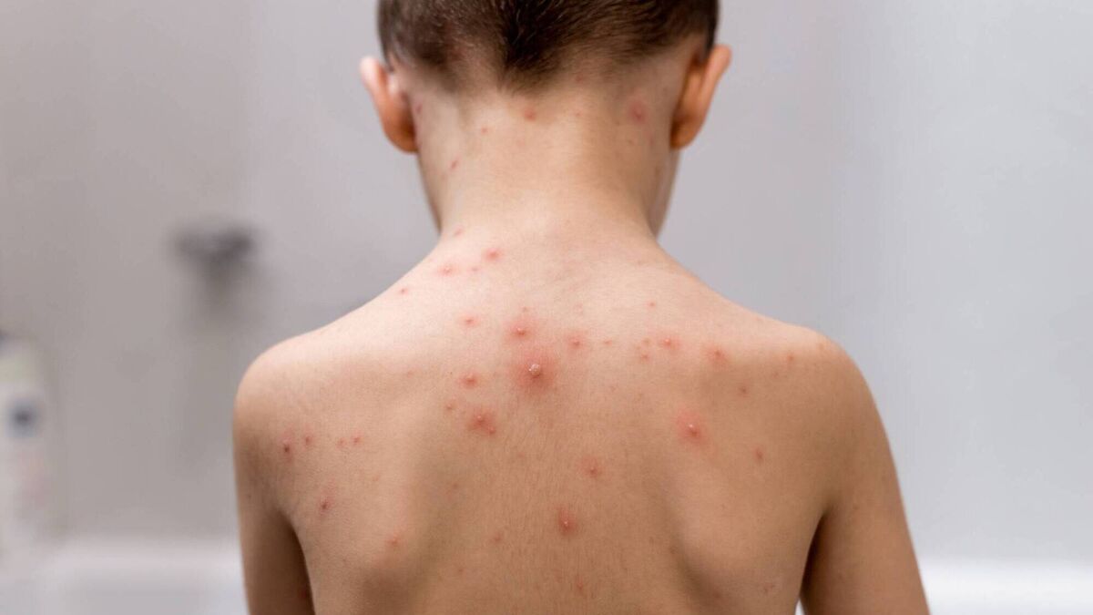 Julie Jay: Like lightning, chicken pox doesn’t strike twice — unless you’re very, very special