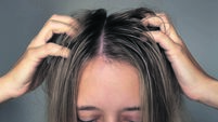 Young woman touching itchy scalp with dirty oily hair, concept of dandruff, seborrhea, irritation