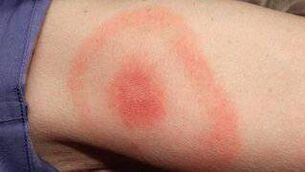 <p>The most common sign of infection is a skin rash, known as Bullseye rash or erythema migrans. File picture: HSE.ie</p>