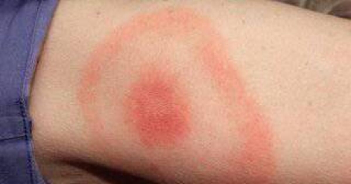 HSE Issues Urgent Lyme Disease and Tick Warning in Ireland