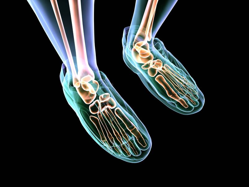 Women tend to develop bunions at a much greater rate than men Women tend to develop bunions at a much greater rate than men