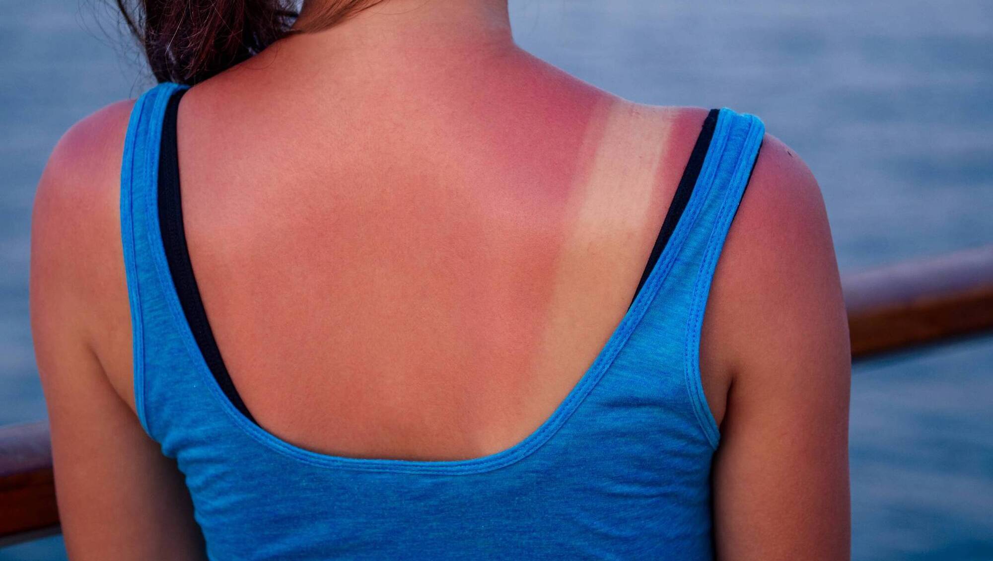 Dr Phil Kieran: Does my daughter need medical help for a serious sunburn on her back?