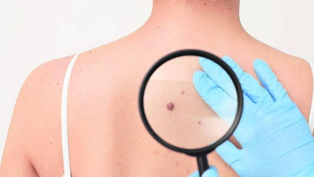 <p>Every year, 1,200 people in Ireland are diagnosed with melanoma. Picture: iStock </p>