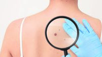 Dermatologist examining patient's birthmark with magnifying glass on beige background, closeup
