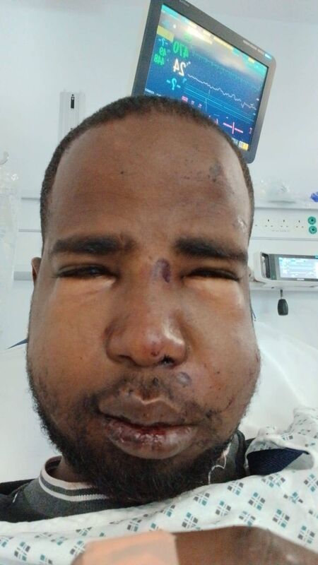 Homeless Somali asylum seeker Hussein suffered a broken jaw and nose after being assaulted by a group of men on Parnell St in Dublin city centre on Friday, June 26. File picture