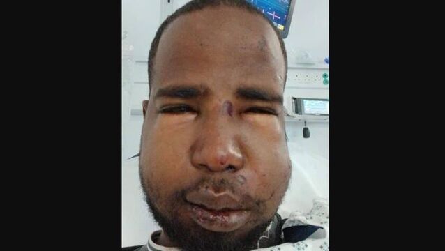<p>Hussein suffered a broken jaw and nose after being assaulted in Dublin.</p>