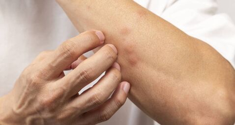 mosquito bits feelgood.jpg A man's arm with insect bites.