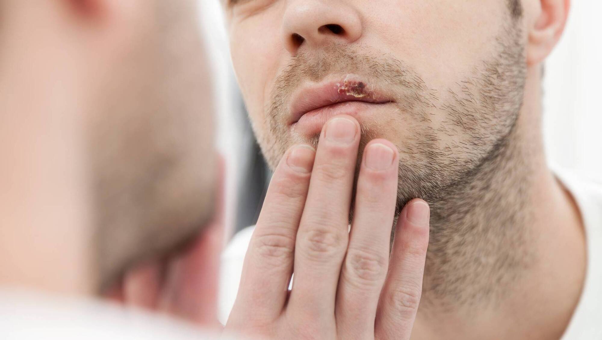 Megan Sheppard: Applying raw garlic to the cold sore is not something that I would recommend Picture: iStock
