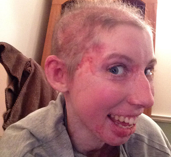 Catrin, shortly after coming out of hospital.