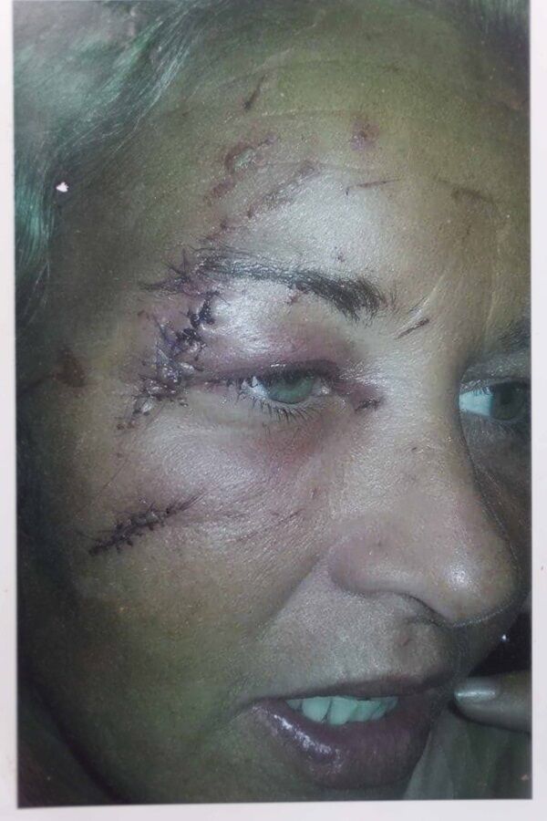 Some of the injuries suffered by Mary McCarthy. Some of the injuries suffered by Mary McCarthy.