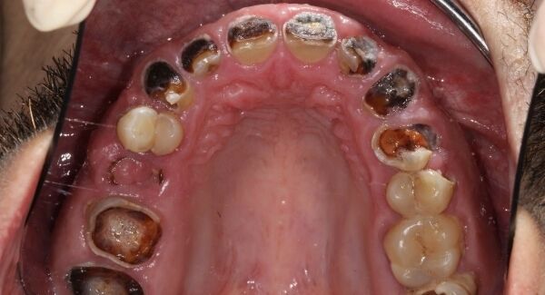 Michael Sheridan's teeth before surgery. Michael Sheridan's teeth before surgery.