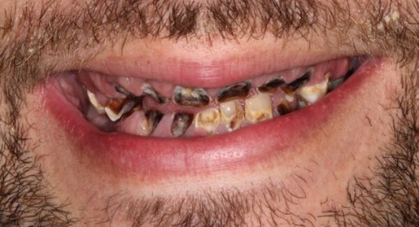 Michael Sheridan's teeth before his implant treatment. Michael Sheridan's teeth before his implant treatment.