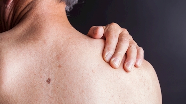 Deep freeze: Understanding the perma frost that is frozen shoulder