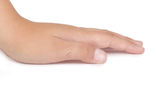 Natural health: My child has developed warts; my hair has become very fine since I had a baby