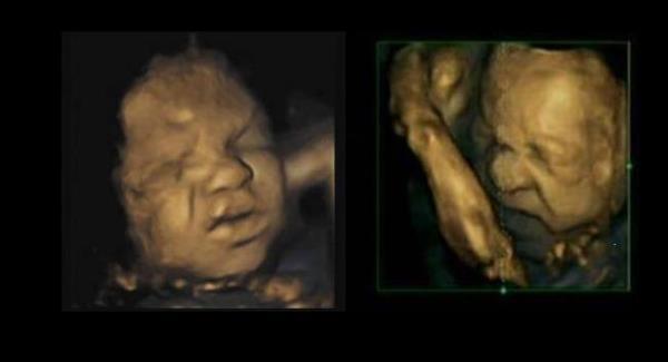 Unborn babies ‘practise’ expressions of pain