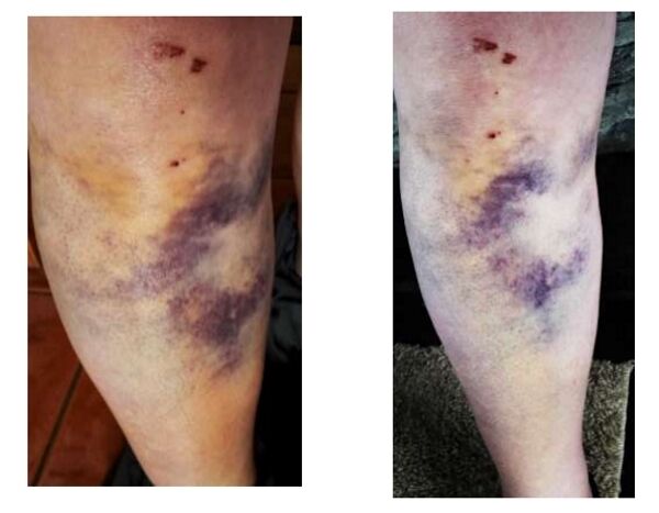 Martha's injuries from the incident Martha's injuries from the incident