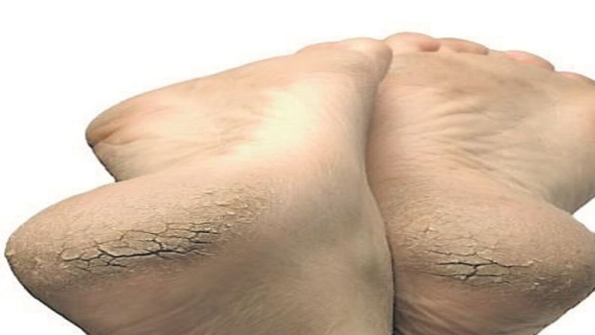 homeopathic remedy for foot cracks