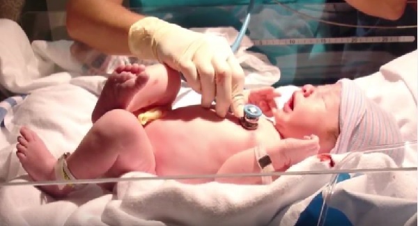 Video: Tongue ties in babies, the untethered truth.