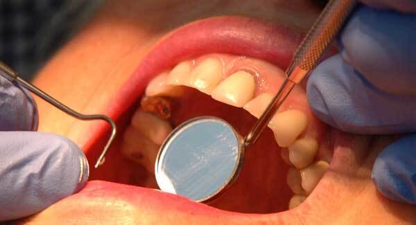 Dentists ‘need kickstart package’ to overcome coronavirus