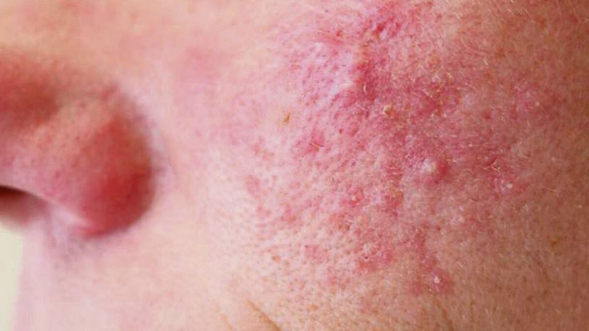 glycolic acid and rosacea