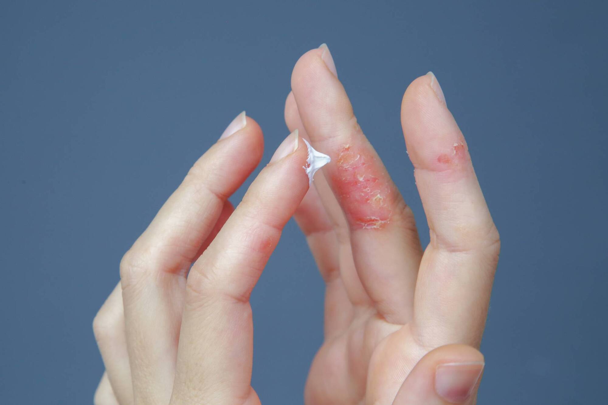 The Skin Nerd: How to deal with eczema