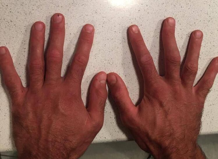 Bugler's hurling hands 