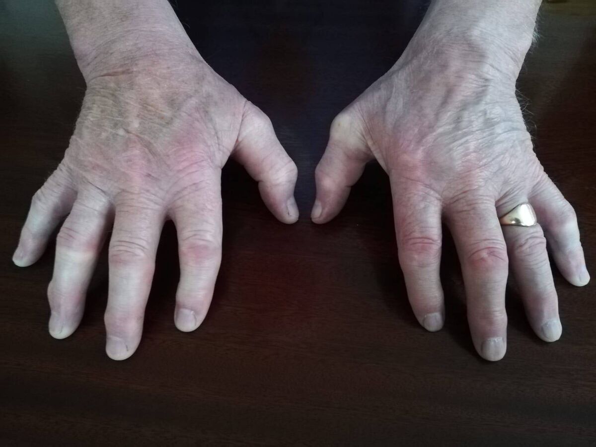 Éamonn Grimes' Hurling Hands