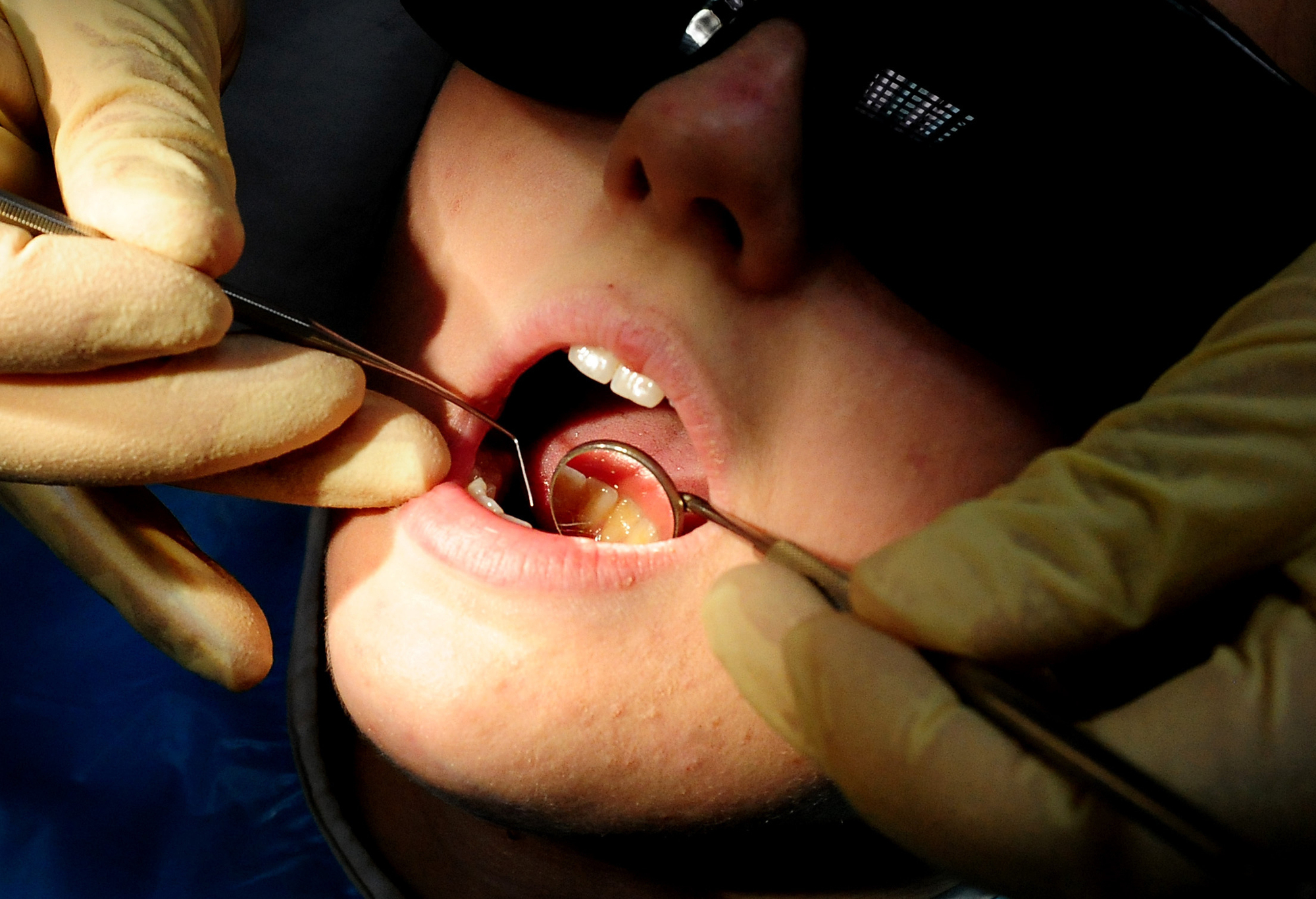 More than 1,500 children waiting for dental extractions
