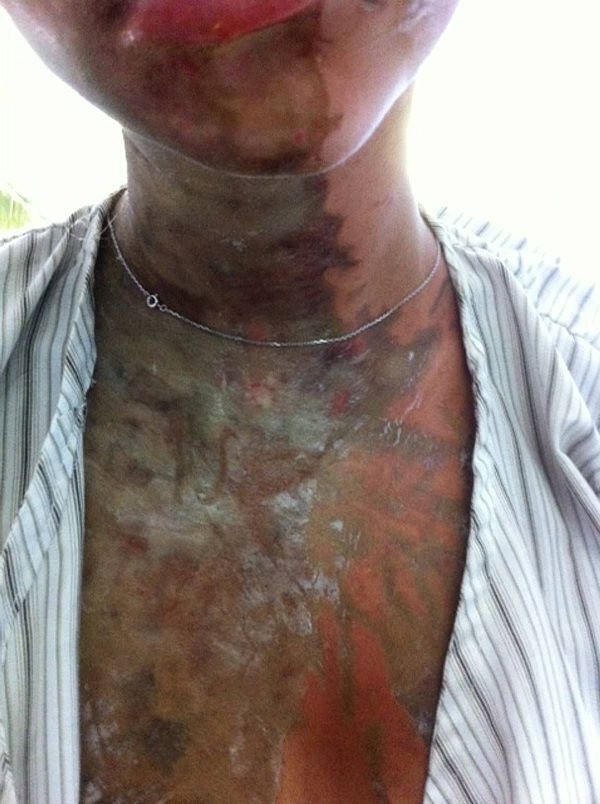 Family release photo of burns suffered by daughter in acid attack