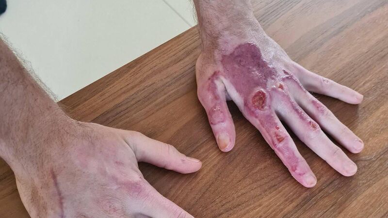 Romain Grosjean shares image of injury from horror crash