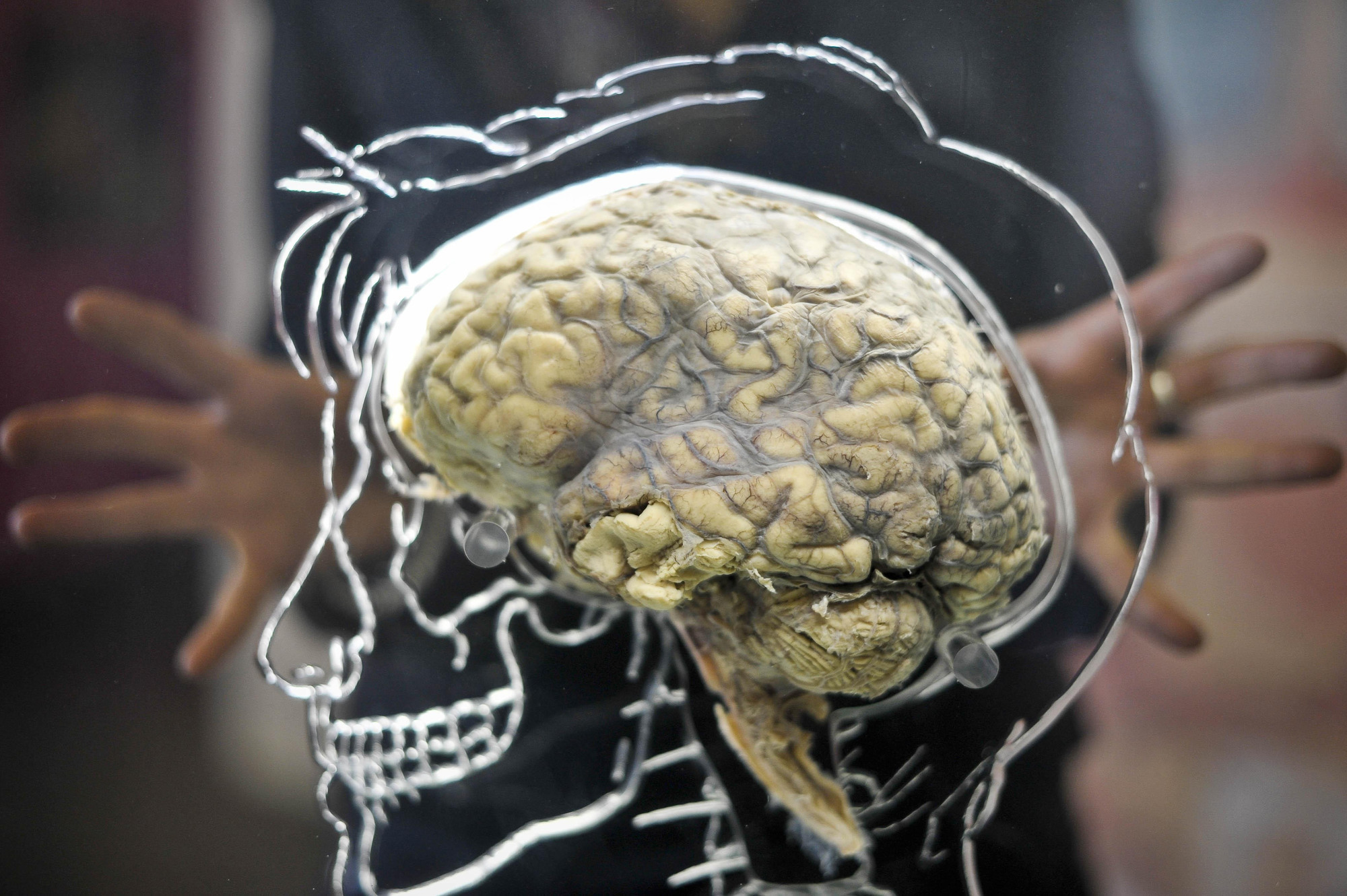 New non-invasive brain stimulation therapy hope for people with tremors