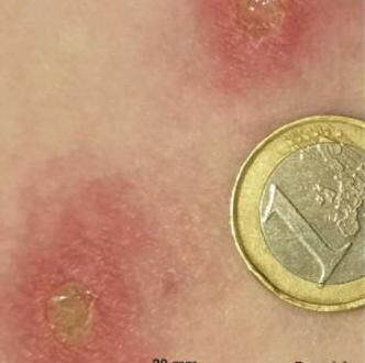 Images of a spider bite. The victim was a 56-year-old female in Cork who was bitten while she was changing clothes. Images of a spider bite. The victim was a 56-year-old female in Cork who was bitten while she was changing clothes.