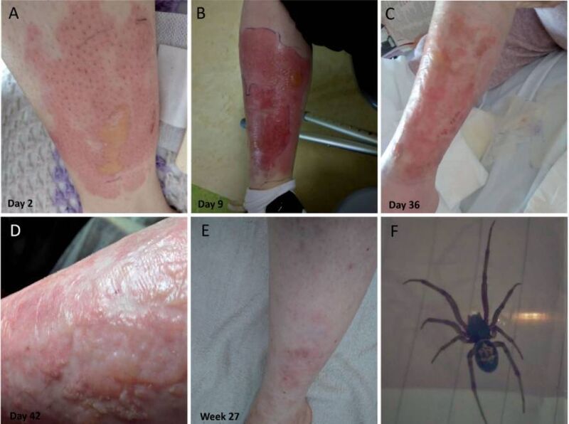 A severe reaction that resulted from three noble false widow bites to the lower left leg. Picture: NUI Galway A severe reaction that resulted from three noble false widow bites to the lower left leg. Picture: NUI Galway