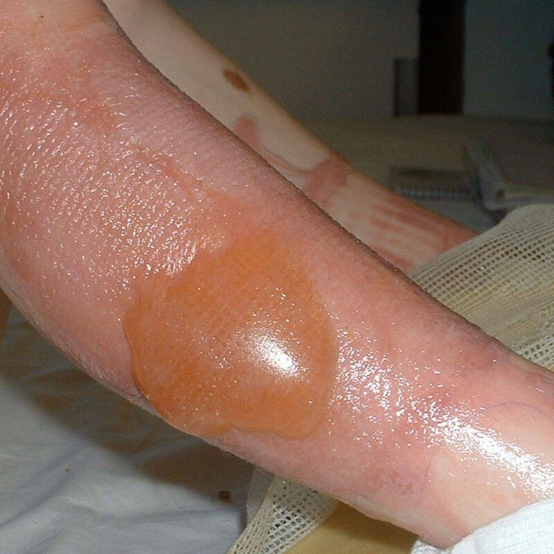 An example of a blister caused by a giant hogweed An example of a blister caused by a giant hogweed