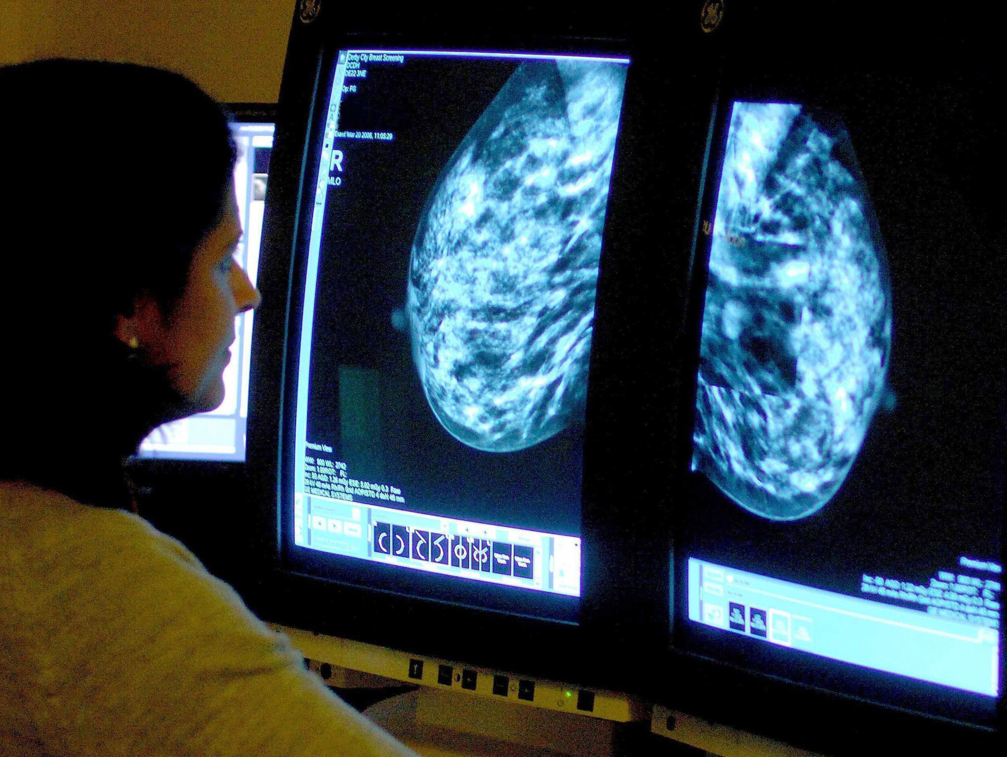 Breast cancer drug ‘found to reduce risk of disease progression’