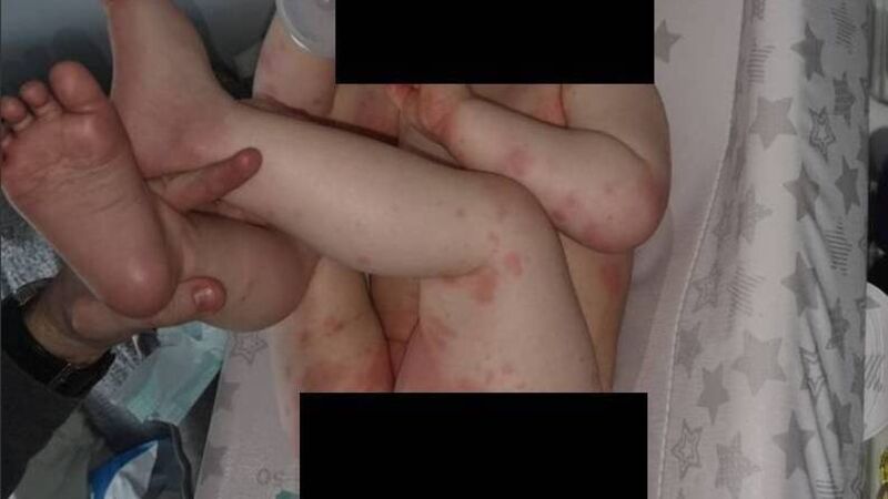 One-year-old Cork boy hospitalised after rash turns out to be rare Covid-related syndrome