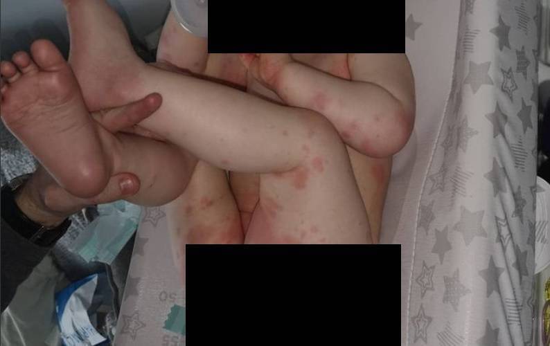 What started as a small rash soon spread all across Jayce Aherne's body. Picture: Emma Aherne/Instagram 