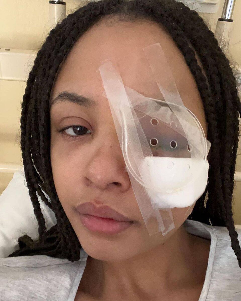 Alanna Quinn Idris sustained serious injury to her eye in the assault. Credit: alannaquinn_idris, Instagram