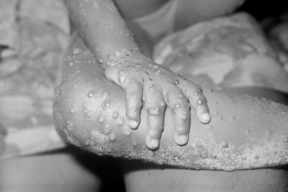 Experts have identified nine cases of Monkeypox in the UK. Alamy/PA. Experts have identified nine cases of Monkeypox in the UK. Alamy/PA.