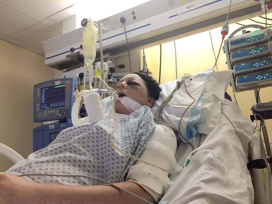 Olivia Keating's injuries included more than 27 fractures to her face and a broken back. Picture courtesy of Olivia Keating