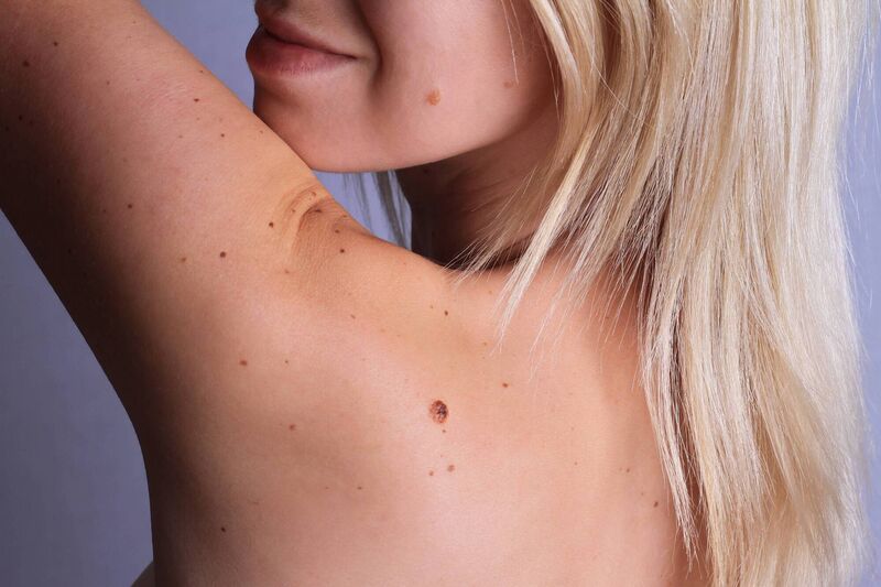 A mole is the result of a mutation within our melanocytes, which causes the cells to grow in a cluster instead of being spread out evenly across our skin, says the Skin Nerd