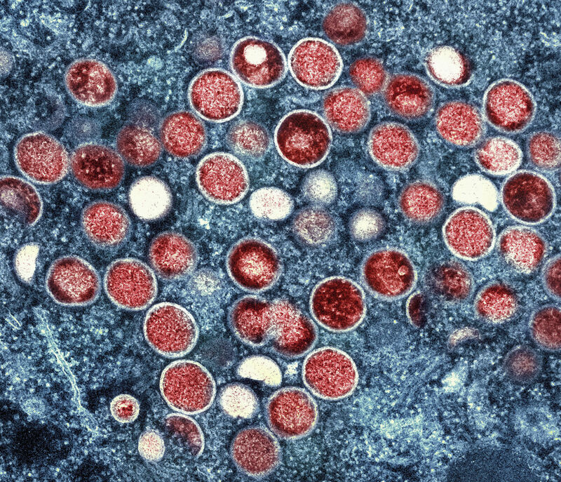 This image provided by the National Institute of Allergy and Infectious Diseases (NIAID) shows a colorized transmission electron micrograph of monkeypox particles (red) found within an infected cell (blue), cultured in the laboratory that was captured and color-enhanced at the NIAID Integrated Research Facility (IRF) in Fort Detrick, Md. The World Health Organization recently declared the expanding monkeypox outbreak a global emergency. It is WHO???s highest level of alert, but the designation does not necessarily mean a disease is particularly transmissible or lethal. (NIAID via AP) This image provided by the National Institute of Allergy and Infectious Diseases (NIAID) shows a colorized transmission electron micrograph of monkeypox particles (red) found within an infected cell (blue), cultured in the laboratory that was captured and color-enhanced at the NIAID Integrated Research Facility (IRF) in Fort Detrick, Md. The World Health Organization recently declared the expanding monkeypox outbreak a global emergency. It is WHO???s highest level of alert, but the designation does not necessarily mean a disease is particularly transmissible or lethal. (NIAID via AP)