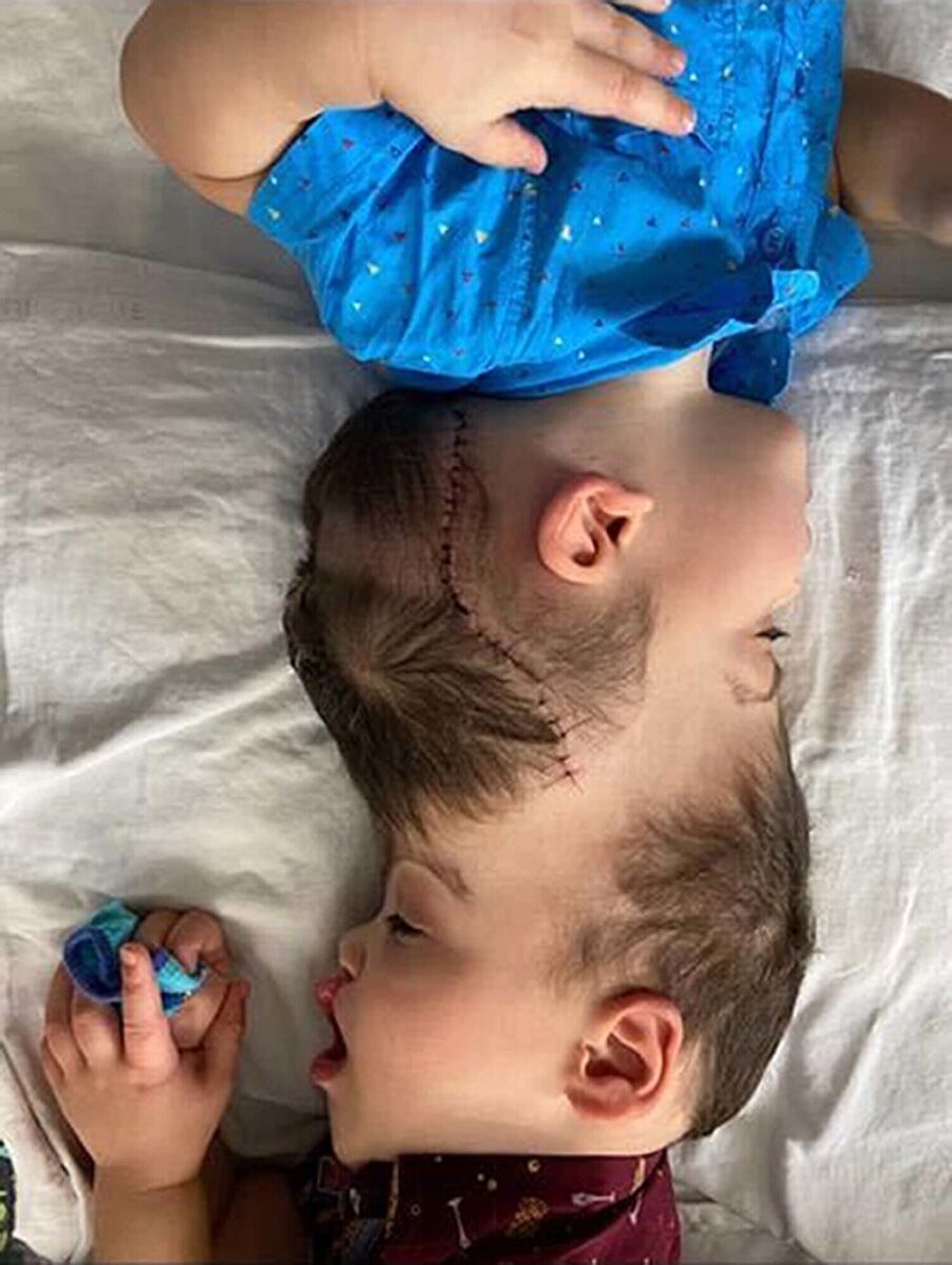 Brazilian twins Bernardo (top) and Arthur Lima before they were separated. Picture: Gemini Untwined/PA