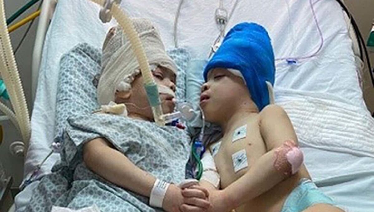 Brazilian twins Bernardo and Arthur Lima who have been successfully separated. Picture: Gemini Untwined/PA
