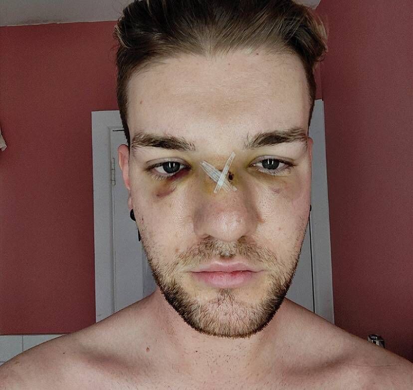 Mark's injuries three days after the assault. He will need to go for an X-ray at a later date when the swelling has subsided to see if his nose is broken. Mark's injuries three days after the assault. He will need to go for an X-ray at a later date when the swelling has subsided to see if his nose is broken.